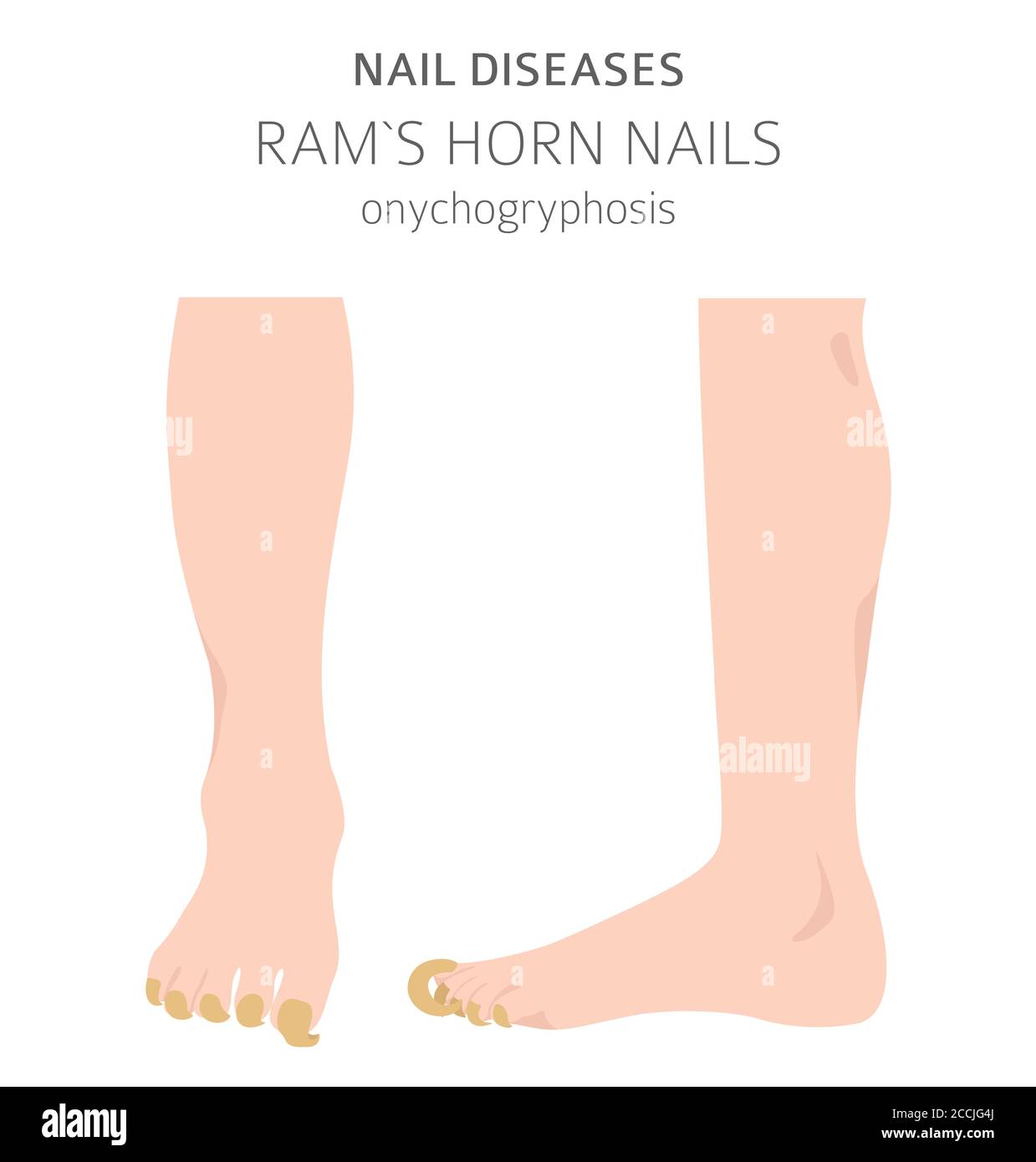 Nail diseases. Onychogryphosis, Ram`s horn nail. Medical infographic design. Vector illustration